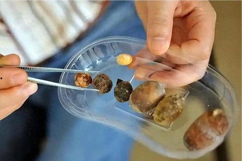 肾结石能吃黑瓜吗女性怎么吃,肾结石患者女性食用黑瓜的适宜方法与注意事项