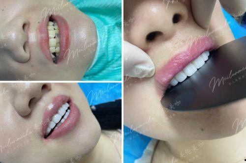 明星网红瓷贴面,明星网红纷纷追捧的口腔美容新风尚