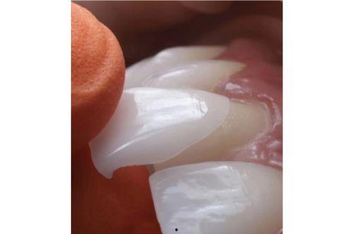 明星网红瓷贴面,明星网红纷纷追捧的口腔美容新风尚