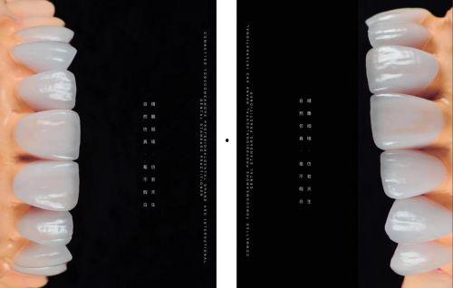 明星网红瓷贴面,明星网红纷纷追捧的口腔美容新风尚