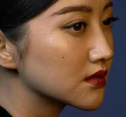 明星网红祛痣,揭秘美容祛痣新潮流